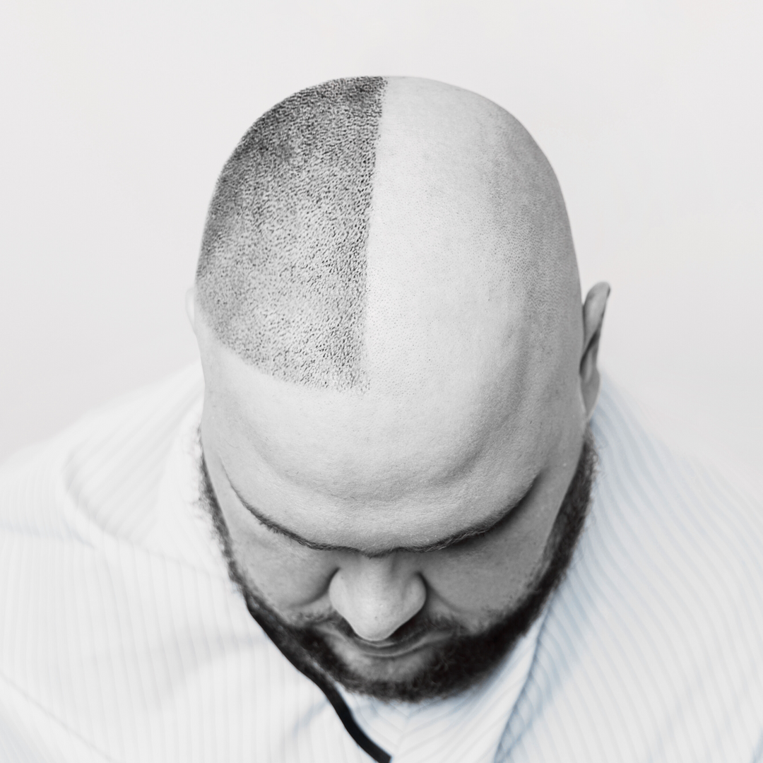 Scalp Micropigmentation